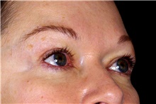 Eyelid Surgery After Photo by Landon Pryor, MD, FACS; Rockford, IL - Case 45597