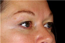 Eyelid Surgery Before Photo by Landon Pryor, MD, FACS; Rockford, IL - Case 45597