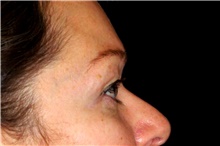 Eyelid Surgery Before Photo by Landon Pryor, MD, FACS; Rockford, IL - Case 45597