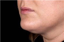 Injectable Fillers Before Photo by Landon Pryor, MD, FACS; Rockford, IL - Case 45606