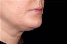 Injectable Fillers Before Photo by Landon Pryor, MD, FACS; Rockford, IL - Case 45606