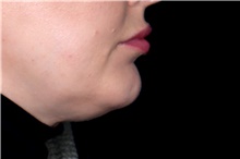 Injectable Fillers After Photo by Landon Pryor, MD, FACS; Rockford, IL - Case 45606