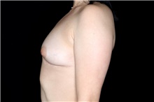 Breast Implant Removal After Photo by Landon Pryor, MD, FACS; Rockford, IL - Case 45669
