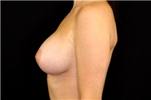 Breast Implant Removal Before Photo by Landon Pryor, MD, FACS; Rockford, IL - Case 45669