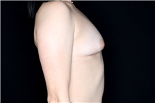 Breast Implant Removal After Photo by Landon Pryor, MD, FACS; Rockford, IL - Case 45669