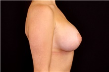 Breast Implant Removal Before Photo by Landon Pryor, MD, FACS; Rockford, IL - Case 45669