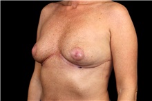 Breast Implant Removal After Photo by Landon Pryor, MD, FACS; Rockford, IL - Case 45671