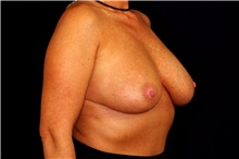 Breast Implant Removal Before Photo by Landon Pryor, MD, FACS; Rockford, IL - Case 45671