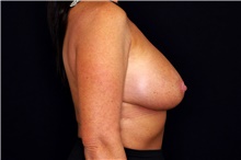Breast Implant Removal Before Photo by Landon Pryor, MD, FACS; Rockford, IL - Case 45671