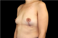 Breast Implant Removal After Photo by Landon Pryor, MD, FACS; Rockford, IL - Case 45672