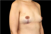 Breast Implant Removal After Photo by Landon Pryor, MD, FACS; Rockford, IL - Case 45672