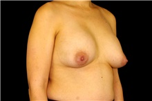 Breast Implant Removal Before Photo by Landon Pryor, MD, FACS; Rockford, IL - Case 45672