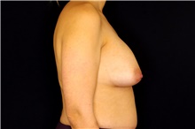 Breast Implant Removal Before Photo by Landon Pryor, MD, FACS; Rockford, IL - Case 45672
