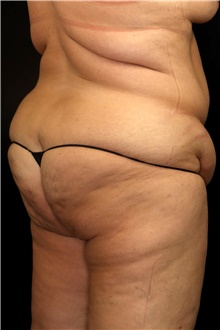 Tummy Tuck Before Photo by Landon Pryor, MD, FACS; Rockford, IL - Case 45676