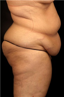 Tummy Tuck Before Photo by Landon Pryor, MD, FACS; Rockford, IL - Case 45676