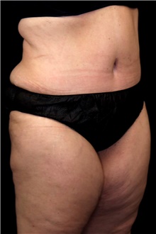 Tummy Tuck After Photo by Landon Pryor, MD, FACS; Rockford, IL - Case 45676