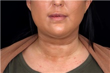 Liposuction After Photo by Landon Pryor, MD, FACS; Rockford, IL - Case 45823