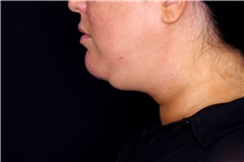 Liposuction Before Photo by Landon Pryor, MD, FACS; Rockford, IL - Case 45823