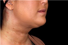 Liposuction After Photo by Landon Pryor, MD, FACS; Rockford, IL - Case 45823