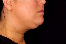 Liposuction Before Photo by Landon Pryor, MD, FACS; Rockford, IL - Case 45823