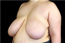 Breast Reduction Before Photo by Landon Pryor, MD, FACS; Rockford, IL - Case 45824