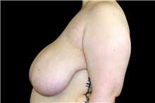 Breast Reduction Before Photo by Landon Pryor, MD, FACS; Rockford, IL - Case 45824