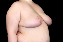 Breast Reduction After Photo by Landon Pryor, MD, FACS; Rockford, IL - Case 45824