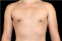 Male Breast Reduction After Photo by Landon Pryor, MD, FACS; Rockford, IL - Case 45829