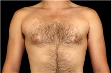 Male Breast Reduction Before Photo by Landon Pryor, MD, FACS; Rockford, IL - Case 45829