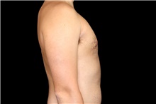 Male Breast Reduction After Photo by Landon Pryor, MD, FACS; Rockford, IL - Case 45829