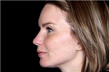 Laser Skin Resurfacing After Photo by Landon Pryor, MD, FACS; Rockford, IL - Case 45831