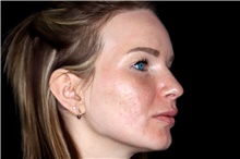 Laser Skin Resurfacing Before Photo by Landon Pryor, MD, FACS; Rockford, IL - Case 45831