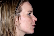 Laser Skin Resurfacing After Photo by Landon Pryor, MD, FACS; Rockford, IL - Case 45831
