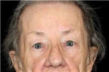 Brow Lift After Photo by Landon Pryor, MD, FACS; Rockford, IL - Case 45833