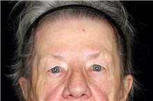 Brow Lift Before Photo by Landon Pryor, MD, FACS; Rockford, IL - Case 45833