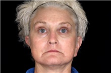 Brow Lift After Photo by Landon Pryor, MD, FACS; Rockford, IL - Case 45834