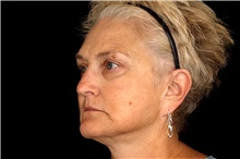 Brow Lift Before Photo by Landon Pryor, MD, FACS; Rockford, IL - Case 45834