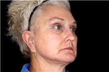 Brow Lift After Photo by Landon Pryor, MD, FACS; Rockford, IL - Case 45834