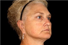 Brow Lift Before Photo by Landon Pryor, MD, FACS; Rockford, IL - Case 45834