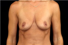 Breast Augmentation Before Photo by Landon Pryor, MD, FACS; Rockford, IL - Case 45835