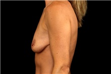 Breast Augmentation Before Photo by Landon Pryor, MD, FACS; Rockford, IL - Case 45835