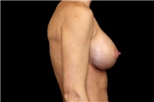 Breast Augmentation After Photo by Landon Pryor, MD, FACS; Rockford, IL - Case 45835