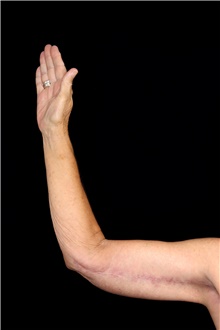 Arm Lift After Photo by Landon Pryor, MD, FACS; Rockford, IL - Case 45837