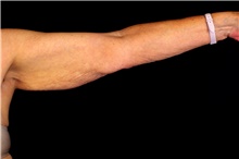Arm Lift Before Photo by Landon Pryor, MD, FACS; Rockford, IL - Case 45837