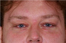 Eyelid Surgery Before Photo by Landon Pryor, MD, FACS; Rockford, IL - Case 45878