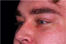 Eyelid Surgery After Photo by Landon Pryor, MD, FACS; Rockford, IL - Case 45878