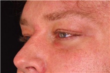 Eyelid Surgery Before Photo by Landon Pryor, MD, FACS; Rockford, IL - Case 45878