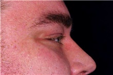 Eyelid Surgery After Photo by Landon Pryor, MD, FACS; Rockford, IL - Case 45878