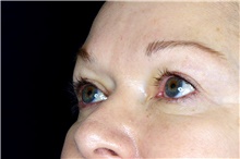 Eyelid Surgery After Photo by Landon Pryor, MD, FACS; Rockford, IL - Case 45883