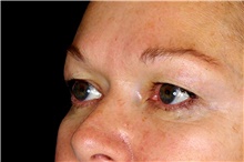 Eyelid Surgery Before Photo by Landon Pryor, MD, FACS; Rockford, IL - Case 45883